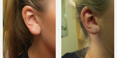 Woman treated with Earlobe Surgery - Woman treated with Earlobe Surgery