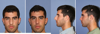 male rhinoplasty - &nbsp;
	Male Rhinoplasty