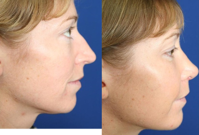 25-34 year old woman treated with Cheek Implants, Chin Implant, Nose Surgery and Fat Grafts - This 26-year-old cosmetic patient presented in our plastic surgery office requesting consultation about multiple facial procedures. She wanted correction of the nose but also improvements around the eyes and possibly bigger chin.After detailed analysis of her facial structure, both bones and soft tissue, we concluded that patient would benefit from augmentation of chin and cheeks with facial implants, nose shaping surgery and fat grafting over cheeks and around the eyes. After thorough discussion we concluded to proceed with rhinoplasty, cheek and chin implants and fat grafting.Her surgery was done in general anesthesia in our office based plastic surgery center. It consisted of external rhinoplasty (nose shaping), chin and cheek augmentation with implants and fat grafting over augmented areas of chin and cheeks and around eyebrows. She was discharged home 1 hour after surgery. She left country on a sailing boat 2 weeks later.Patient is shown before multiple facial implant surgery and nose surgery on the left. Postoperative images on the right show patient 6 months after chin and cheek silicone implant augmentation, nose surgery and fat graft placement. Notice how her elongated, bonny, ascetic face turned into fuller, oval shaped, more harmonious one after multiple facial surgeries.