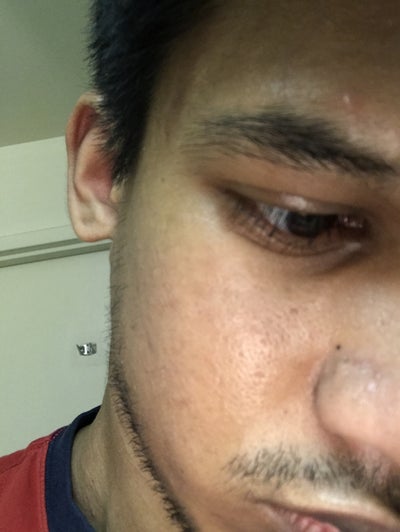 Will the bumps on my nose go away? (photos) Doctor Answers, Tips