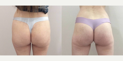 Butt Augmentation Using Sculptra Aesthetic - Before and After 1st Nonsurgical Butt Lift Treatment using Sculptra. This treatment, or series of treatments, works by growing your own collagen to add volume to the butt and/or hips, with the added bonus of smoothing stretch marks and the appearance of cellulite. The Sculptra Butt Augmentation has no downtime and aftercare involves deep massage for 5 minutes, 5x a day, for the first 5 days following treatment. Many of my patients are post surgical-BBL and this treatment is used to smooth and enhance their surgical results. This is also an excellent option for lean patients that do not have available fat to transfer, or those afraid of surgery.