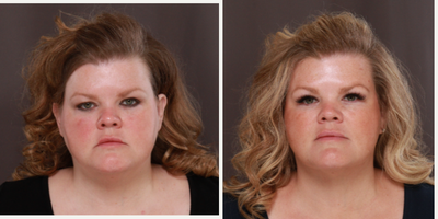 35-44 year old woman treated with MACS Facelift, Eyelid Surgery - MACSlift and Upper Blepharoplasty Surgery