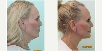 45-54 year old woman treated with Neck Lift and Lower Facelift under Local Anesthesia - This female patient presented with the main concern of what she described as turkey neck (similar to what her mother had in her 50's). She did not care for the significant excess skin, fat, and overall looseness under her chin. She had tried numerous creams and non-surgical treatments, such as radiofrequency, with no significant results.During initial consultation it was determined that she had significant laxity of her neck, but also of her lower face and jawline tissue. We decided to perform a lower facelift and necklift under local anesthesia in our Center with the assistance of oral sedation with valium (No general or IV anesthesia necessary). Her procedure time was approximately one hour and 50 minutes.Her results demonstrate major improvement in her neckline, as well as a sharpened and more visible jawline. All sutures were removed by day 12, and was thus able to return to both work and her full physical activities.