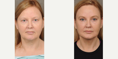 35-44 year old woman treated with Facelift, Mini Neck Lift - Our patient wanted to look more rejuvinated so that we performed face lift and neck lift.