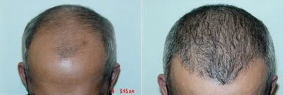  Hair Transplant   - 	Male pattern baldness (Alopecia) corrected/treated using the most advanced surgical hair restoration techniques
