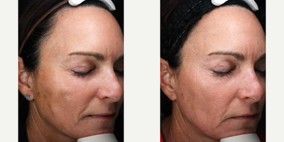35-44 year old woman treated with LaseMD - This patient was hoping to improve the appearance of her skin which had been impacted with significant sun damage.  She had three lase MD treatments, and her brown spots became significantly lighter.  She also had skin tightening with fewer lines around her eyes and jaw line.  She also has had collagen improvement as her cheeks are more full.