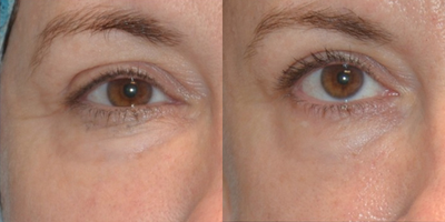 45-54 year old woman treated with Fractional Laser - This patient had concerns of periorbital aging, wrinkling, and poor texture. Fractional radiofrequency (Sublative) was performed with 3 treatments.