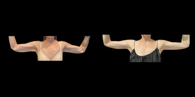 55-64 year old woman treated with Arm Lift - An arm lift, or brachioplasty, is a surgical procedure designed to remove excess skin and fat from the upper arms to create a slimmer, more toned appearance. This procedure is ideal for individuals who experience sagging or loose skin due to aging or significant weight loss. By tightening the underlying tissues and removing unwanted skin, an arm lift enhances arm contours and restores a more youthful, sculpted look. Results are long-lasting, and with proper care, scars typically fade over time.