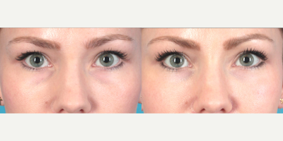 25-34 year old woman treated with Belotero - Before and after treatment of dark under-eye circles with Belotero.
