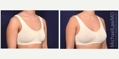 25-34 year old woman treated with Sientra Breast Implants - Breast augmentation. Follow-up photos taken 6 months after the procedure.