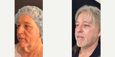 Man treated with Neck Lift - Man treated with Deep Plane Facelift, Neck Lift, Eyelid Surgery to upper eyelids, and Facial Fat Transfer. Post-op, he had masculine improvements in his neck, jawline, cheeks, and eyes.