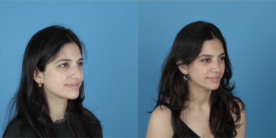 18-24 year old woman treated with Rhinoplasty - Droopy nose tip,deviated septum,wide nostrils