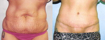 38 year old Female underwent tummy tuck and minor liposuction - 
	38 year old female unhappy with her abdomen following childbirth and a 70 lb weight loss. Patient underwent abdominoplasty and small amount of liposuction to her waist and hips.
