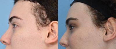 18-24 year old woman treated with Hair Loss Treatment - 18-24 year old woman treated with Hair Loss Treatment
