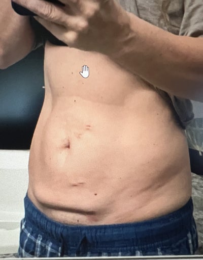 I look 'butchered after botched' £3,500 tummy tuck left me with giant  hip-to-hip scar