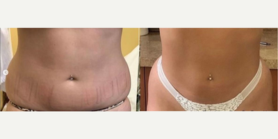Woman treated with Evolve - Woman treated with Evolve.