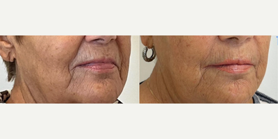 75 and up year old woman treated with PRP Injections - Results after just one treatment of PRF. PRF is platelet rich fibrin and is 100% your body's own blood product rich in your own growth factors and stem cells. It gives great regenerative results for under eyes and around the mouth. Best results are 2 treatments 6 weeks apart.