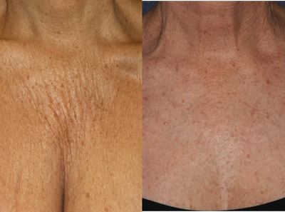 65 yo female treated for Chest wrinkles with Sculptra - 65 yo female treated for Chest wrinkles with Sculptra and IPL for brown spots