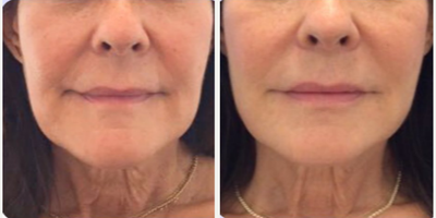 Woman treated with RHA Collection Fillers, Botox, Kybella, Fraxel Laser - Treatment ResultFiller, Botox, and Kybella around the lower face. Fraxel Laser on neck