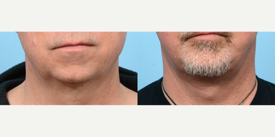 55-64 year old man treated with Deep Plane Facelift, Chin Implant - Looking to reduce submental fat and sagging jowls, this 56-year-old patient came to Dr. Wise for a Deep Plane Facelift. With a primary focus on rejuvenating the midface and lower face, he paired it with a chin implant to help improve overall facial balance.