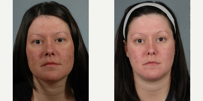 35-44 year old woman treated with Obagi Nu-Derm - 35-44 year old woman treated with Obagi Nu-Derm