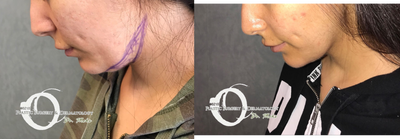 18-24 year old woman treated with Chin Liposuction - Chin Lipo
