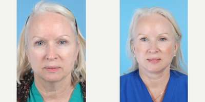 58 year old woman treated with Fraxel Repair - A 58 year-old woman before and after Cheek and Neck Lift w/Anterior Platysmaplasty followed by a second stage Fractionated CO2 (Fraxel Repair) laser skin resurfacing by Andrew T. Lyos M.D., FACS.