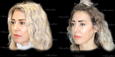 45-54 year old woman treated with Facial Fat Transfer, Eyelid Surgery - This 45-year-old patient underwent Facial Fat Transfer and Eyelid Surgery to achieve a more youthful and refreshed appearance. The facial fat transfer was performed to restore lost volume and enhance facial contours, while the eyelid surgery (blepharoplasty) addressed sagging skin and rejuvenated the eye area. These procedures combined delivered natural and harmonious results, highlighting her facial features. The post-operative results, captured 1 year later, show significant improvements, reflecting both the patients goals and the meticulous approach of the surgical team.