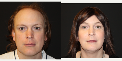 45-54 year old woman treated with MTF Facial Feminization Surgery - Facial feminization surgery with forehead bone contouring, brow lift, cheek augmentation, jawline reduction and genioplasty.