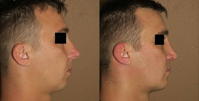 Patient treated with Chin Implant - Shaping faces. Here is a powerful combo of chin enlargement and nose job! Both procedures in combination provide balance to the face