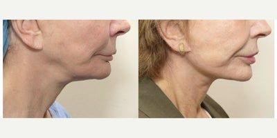 MyEllevate Plus for neck - 77 year old female who was complaining of the laxity of her neck and lack of jawline definition. She underwent the MyEllevate Plus procedure under local anesthesia which includes the placement of a permanent suture support system through tiny skin punctures under the border of the mandible to increase jawline definition, division of the muscle bands of the neck to enhance neck contour, and a skin tuck behind the ear to remove excess skin.
