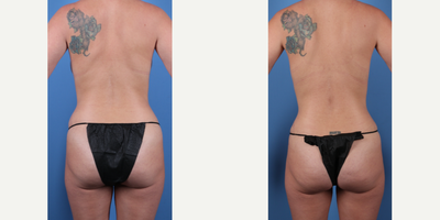 34 year old woman treated with Mommy Makeover, Tummy Tuck w/Liposuction, and Breast Implant Exchange Silicone w/ Galaflex (Derma - Dr. Sukkar preformed a customized Mommy Makeover that consisted of a LipoAbdominoplasty (Tummy Tuck w/Liposuction) and a bilateral breast implant exchange Saline implants to Silicone implants on this 34 year old patient. HT: 5'4WT: 127lbsMentor Silicone Breast Implants Ultra High Profile 535 cc (Rt/Lt)Implant Placement: Subpectoral Incision approach: Inframammary Fold