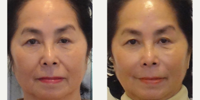 65-74 year old woman treated with Radiesse - Radiesse is used to efface the laugh lines. Post-injection photo shows an immediate, satisfying result with minimal bruising and swelling using the cannula technique.