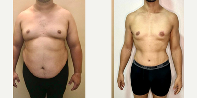 25-34 year old woman treated with Gynecomastia Surgery, Abdominal Etching, Male Tummy Tuck - 25-34 year old woman treated with Gynecomastia Surgery, Abdominal Etching, Male Tummy Tuck
