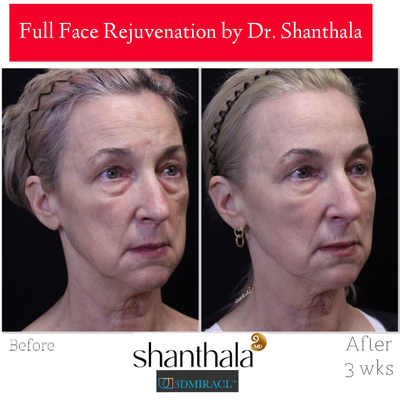 Botox, Fractional Laser, Laser Resurfacing, Nonsurgical Facelift, RHA Collection Fillers - Non Surgical Full Face Rejuvenation by Dr. Shanthala