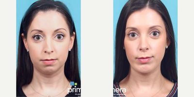 25-34 year old woman treated with Rhinoplasty, Cheek Implants, Chin Implant - This Orlando, FL woman was bothered by breathing issues, the dorsal hump on the bridge of her nose, a drooping nasal tip, her recessed chin, and excess skin under her chin. Dr. Gross recommended Rhinoplasty, Chin Implant, & Submentoplasty. to create harmony with her 3 main areas of concern: nose, chin, and jawline. Her nose now has a slight slope along the bridge with an upturned tip. The vertical lengthening chin implant (from Implantech) evens out the proportions of her face in profile, and the chin tuck (platysmaplasty) provides definition to her jawline and tightens the muscles in her neck. She couldn't be happier with her results!