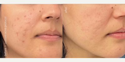 Woman treated with AviClear, Skin Rejuvenation - Say goodbye to stubborn acne with AviClear! Our customized treatment targets acne at the source without harsh chemicals, giving you clearer skin naturally.