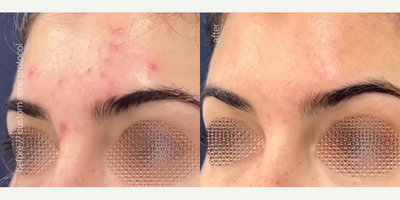 Woman treated with AviClear, Skin Rejuvenation - Dont let acne hold you back! Our personalized acne treatments tackle the problem at its core. See the transformation in these incredible before and after photos. Your clear skin journey starts here!