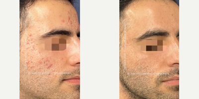 Man treated with AviClear, Skin Rejuvenation - Transform Your Skin: Start Our Custom Acne Protocol and Boost Your Confidence Now!AviClearCustom Laser TreatmentsMonthly Diamond Glow FacialsConsistent Skincare Routine