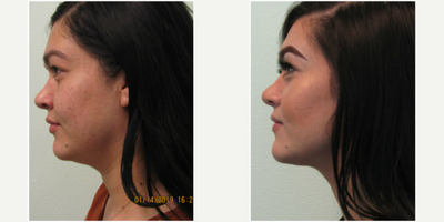 25-34 year old woman treated with Chin Liposuction under Local Anesthesia - This young woman presented with the concern of too much fullness under her chin.  She stated that many of her family members had the same issue even though they were all relatively fit and healthy.  She wished for a permanent and effective treatment that could be performed in one appointment.  Together we decided that submental/chin liposuction would be the most effect and permanent treatment. The procedure was performed under local anesthesia along with mild oral sedation with xanax to relax her anxiety.  The treatment took under one hour to perform and she was back at work in one week's time.