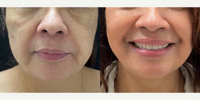 45-54 year old woman treated with Facelift, Deep Plane Facelift, Facelift Revision, SMAS Facelift, Facial Fat Transfer - Patient wanted a more youthful appearance of her face