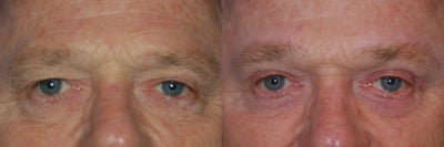 Eyelid, Male - 	Eyelid, Male