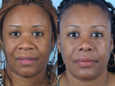 35 Year-Old-Woman Desires a Thinner Nose - 
	Many African Americans are concerned with the width of the tip and nostrils. Rhinoplasty techniques can narrow the nasal base and the flare of the nostrils.

