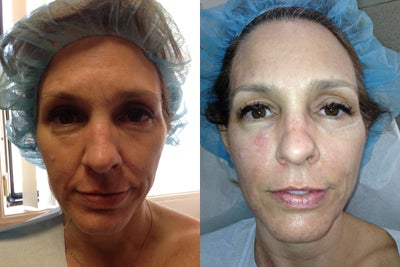 Ulthera and fillers - 
	Ultherapy and dermal fillers can restore volume and lift the face, neck and eyes
