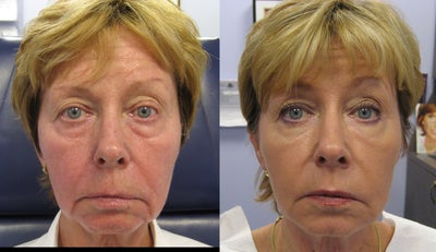 Full face rejuvenation with Botox, dermal fillers and laser - Patient in her 60's was treated with dermal fillers to restore youthful shape of cheeks, Botox and lasers.