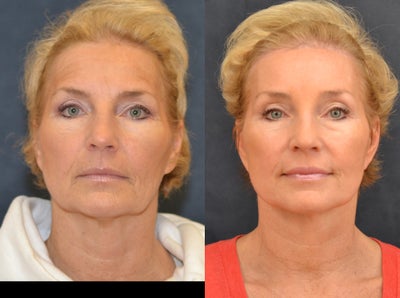 Browlift, minilift - 
	Browlift, minilift and 35% TCA peel
