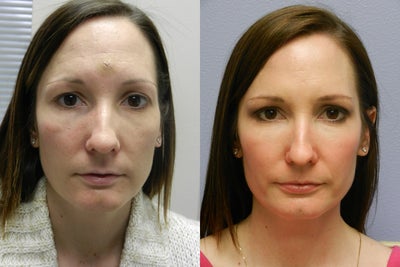 Before and After Skin Care - 
	Pt started on one of our personalized Vargas skin care regimens. Pt after photo's are 3 months after starting skin care. Notice the acne breakouts gone and the glowing tone of her skin, she is thrilled with her new skin!
