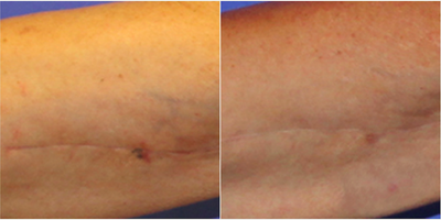 Arm lift scar before and after treatment with embrace - Photo provided courtesy of Neodyne Biosciences, Inc.
