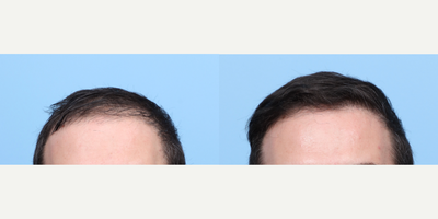 35-44 year old man treated with FUE Hair Transplant, Hair Transplant, Hair Loss Treatment, PRP for Hair Loss - Dr. Wise performed an FUE hair transplant on this patient to fill in his hairline and add density, using 3,025 grafts. During the procedure, he also did a treatment of PRP therapy to fortify the follicles and expedite the healing process.