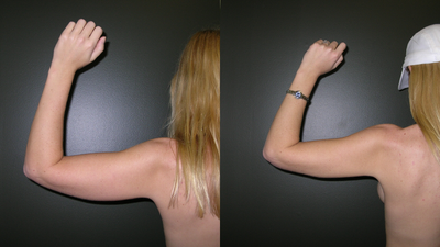Liposuction of Arms - This patient was bothered by excess fatty tissue on the lower aspect of her upper arms.  Tumescent Liposuction was performed on her upper arms bilaterally.  The procedure took approximately 45 minutes and she was discharged to home after a one hour stay in our recovery room.